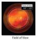 VOLK QUADR PEDIATRIC ( VQPED ) Retinopatia wcześniaków ROP