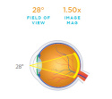 Direct Image High Mag SSV® (ACS®) Lens