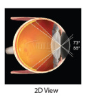 VOLK Central Retinal SSV ACS autoklaw VCRLVITSSVACS